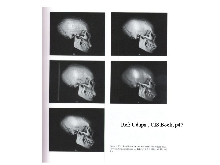 Ref: Udupa , CIS Book, p 47 
