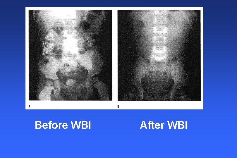 Before WBI After WBI Before WBI After WBI