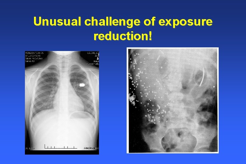 Unusual challenge of exposure reduction! Unusual challenge of exposure reduction!