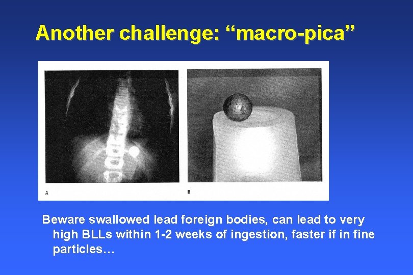Another challenge: “macro-pica” Beware swallowed lead foreign bodies, can lead to very high BLLs Another challenge: “macro-pica” Beware swallowed lead foreign bodies, can lead to very high BLLs
