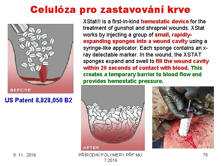 Celulóza pro zastavování krve XStat® is a first-in-kind hemostatic device for the treatment of