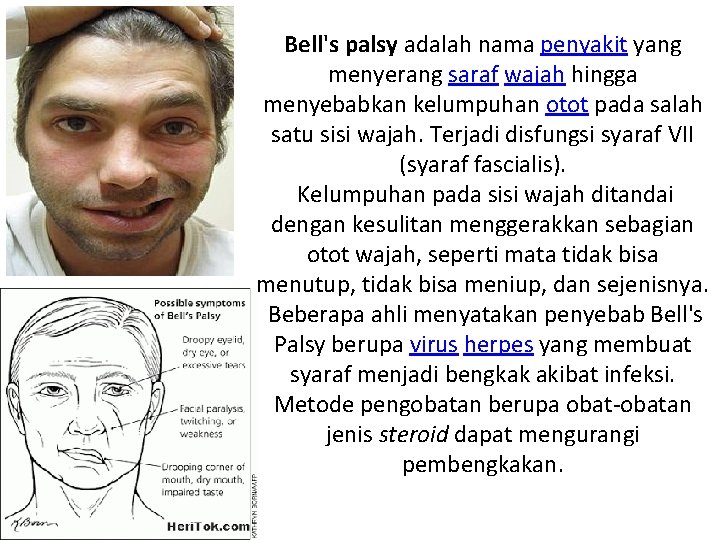 Bell's palsy adalah nama penyakit yang menyerang saraf wajah hingga menyebabkan kelumpuhan otot pada