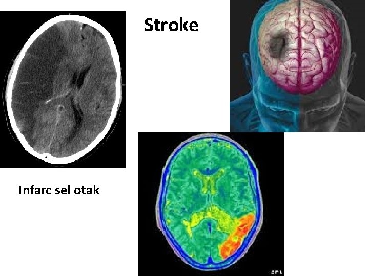 Stroke Infarc sel otak 