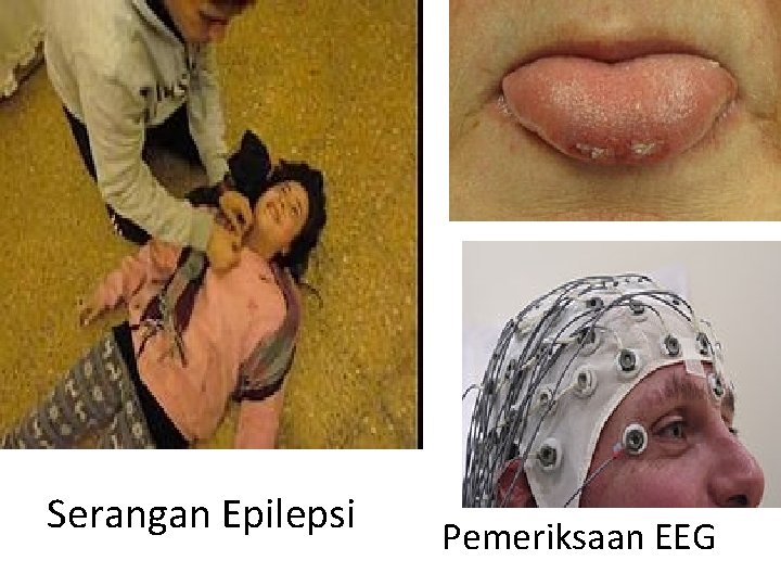 Serangan Epilepsi Pemeriksaan EEG 