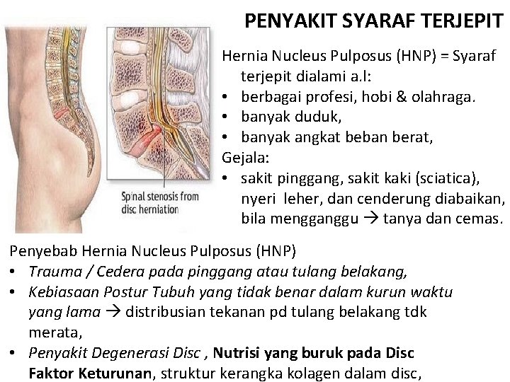 PENYAKIT SYARAF TERJEPIT Hernia Nucleus Pulposus (HNP) = Syaraf terjepit dialami a. l: •