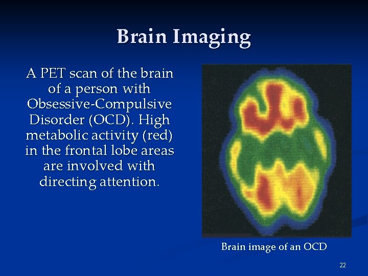 Brain Imaging A PET scan of the brain of a person with Obsessive-Compulsive Disorder