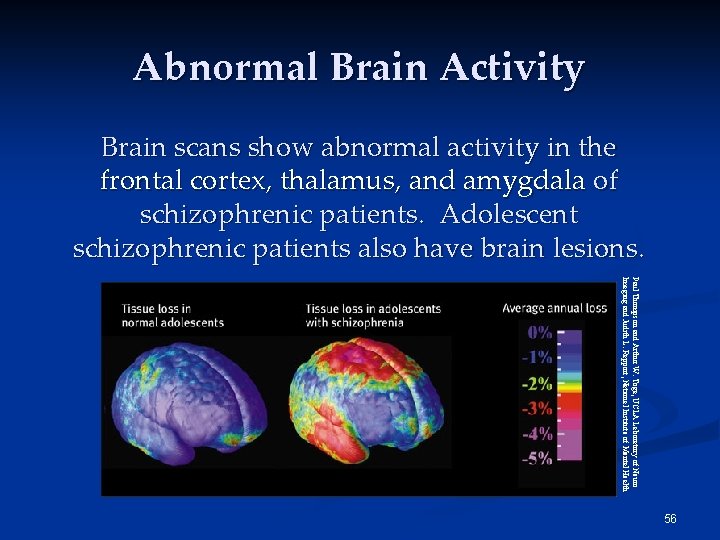 Abnormal Brain Activity Brain scans show abnormal activity in the frontal cortex, thalamus, and