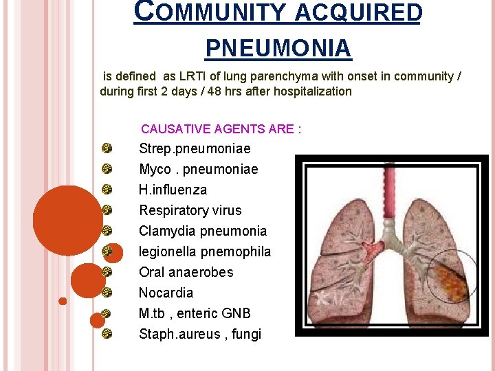 COMMUNITY ACQUIRED PNEUMONIA is defined as LRTI of lung parenchyma with onset in community