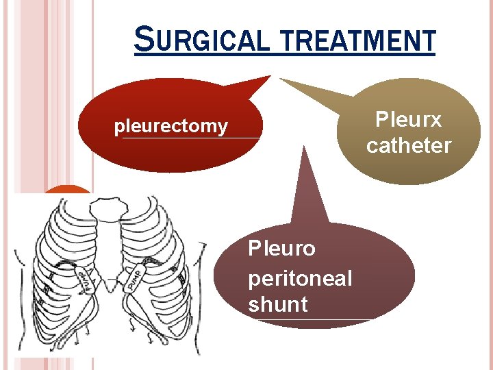 SURGICAL TREATMENT Pleurx catheter pleurectomy Pleuro peritoneal shunt 