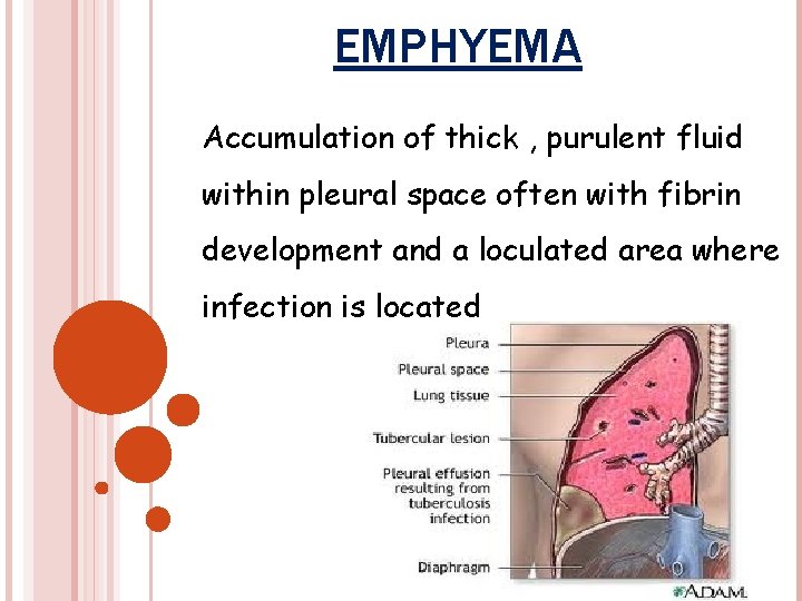 EMPHYEMA Accumulation of thick , purulent fluid within pleural space often with fibrin development