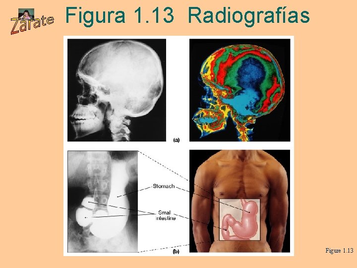 Figura 1. 13 Radiografías Figure 1. 13 