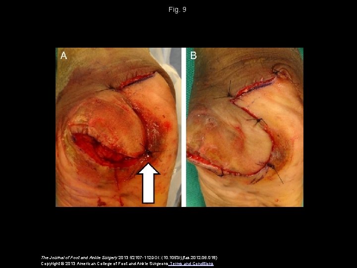 Fig. 9 The Journal of Foot and Ankle Surgery 2013 52107 -112 DOI: (10.