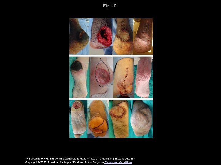 Fig. 10 The Journal of Foot and Ankle Surgery 2013 52107 -112 DOI: (10.