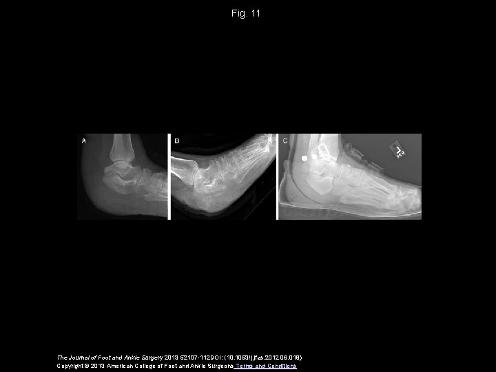 Fig. 11 The Journal of Foot and Ankle Surgery 2013 52107 -112 DOI: (10.