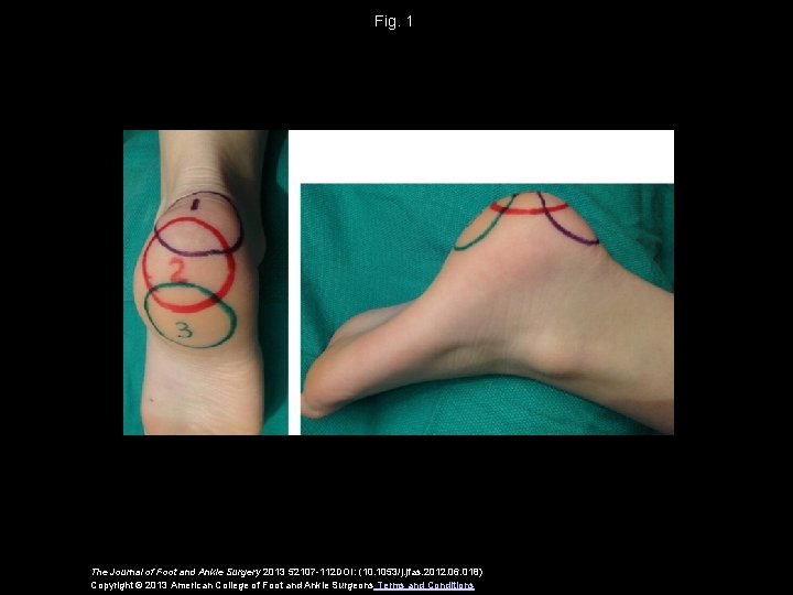 Fig. 1 The Journal of Foot and Ankle Surgery 2013 52107 -112 DOI: (10.