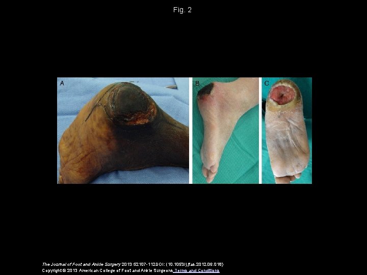Fig. 2 The Journal of Foot and Ankle Surgery 2013 52107 -112 DOI: (10.