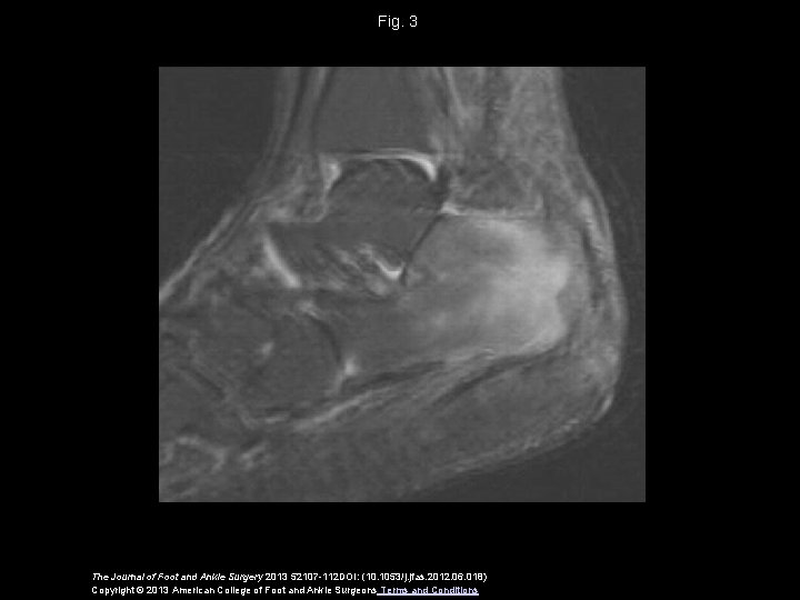 Fig. 3 The Journal of Foot and Ankle Surgery 2013 52107 -112 DOI: (10.