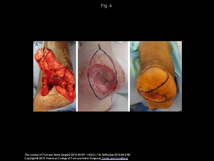 Fig. 4 The Journal of Foot and Ankle Surgery 2013 52107 -112 DOI: (10.