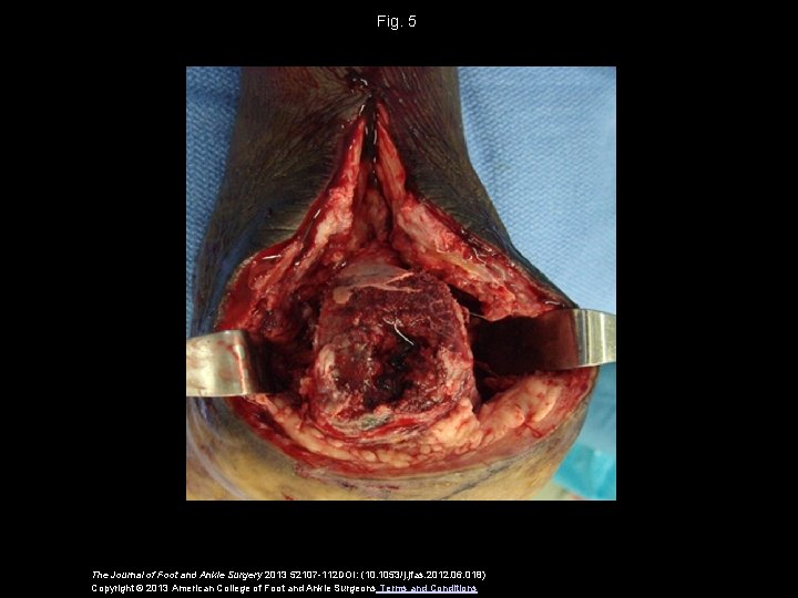 Fig. 5 The Journal of Foot and Ankle Surgery 2013 52107 -112 DOI: (10.
