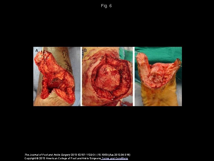 Fig. 6 The Journal of Foot and Ankle Surgery 2013 52107 -112 DOI: (10.