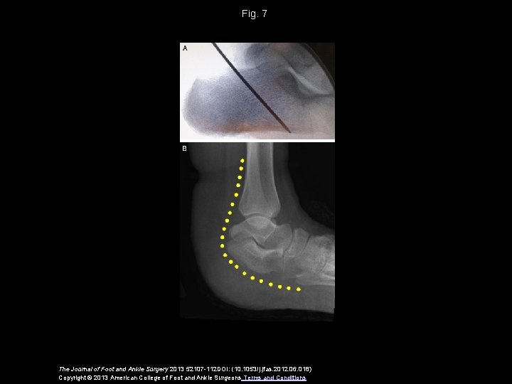 Fig. 7 The Journal of Foot and Ankle Surgery 2013 52107 -112 DOI: (10.