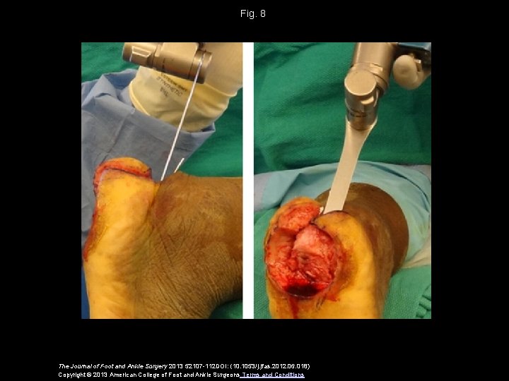 Fig. 8 The Journal of Foot and Ankle Surgery 2013 52107 -112 DOI: (10.
