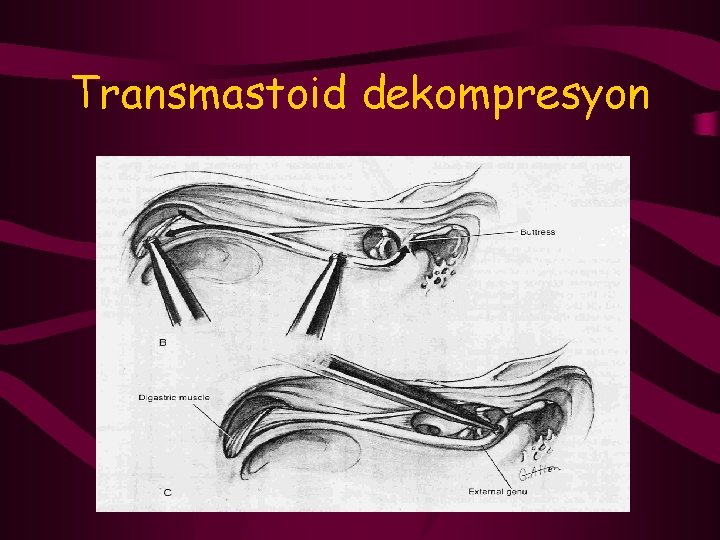 Transmastoid dekompresyon 