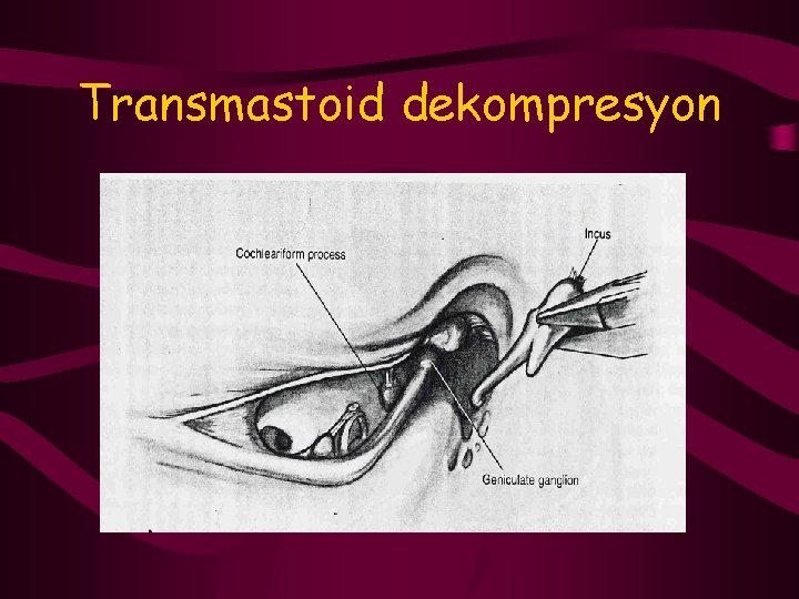 Transmastoid dekompresyon 