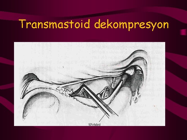 Transmastoid dekompresyon 