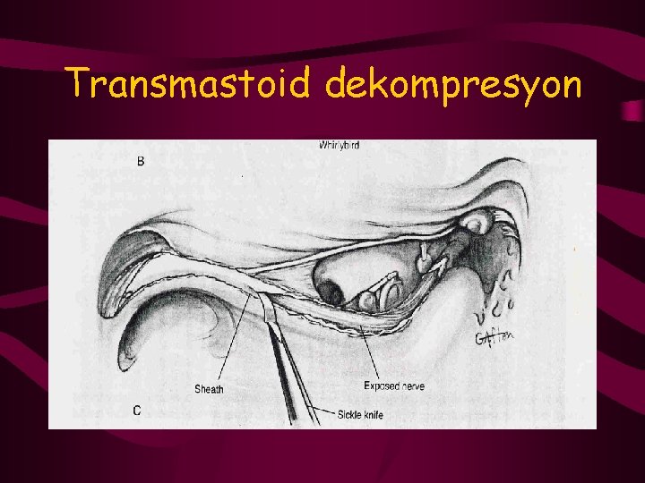 Transmastoid dekompresyon 