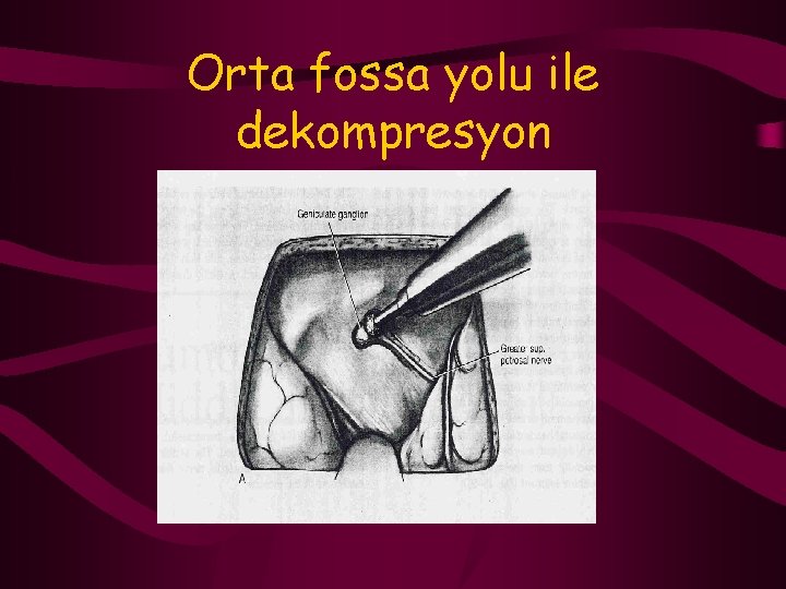 Orta fossa yolu ile dekompresyon 