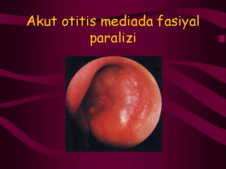 Akut otitis mediada fasiyal paralizi 