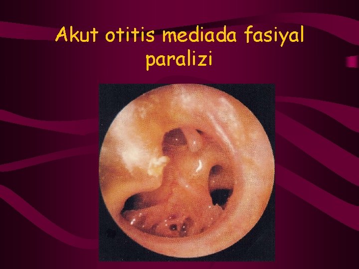 Akut otitis mediada fasiyal paralizi 