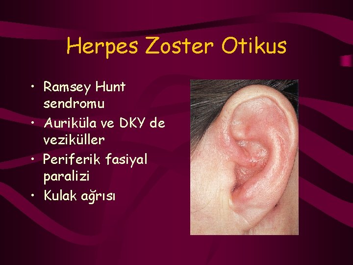 Herpes Zoster Otikus • Ramsey Hunt sendromu • Auriküla ve DKY de veziküller •