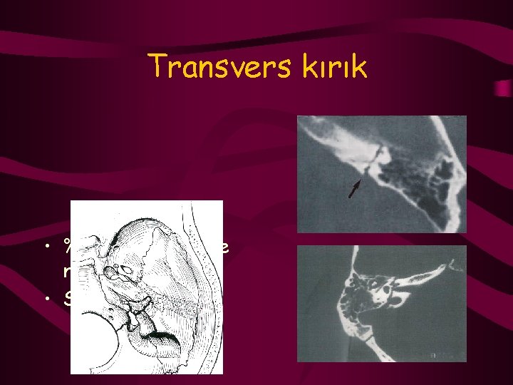 Transvers kırık • % 50’ si paraliziye neden olur • SNİK 