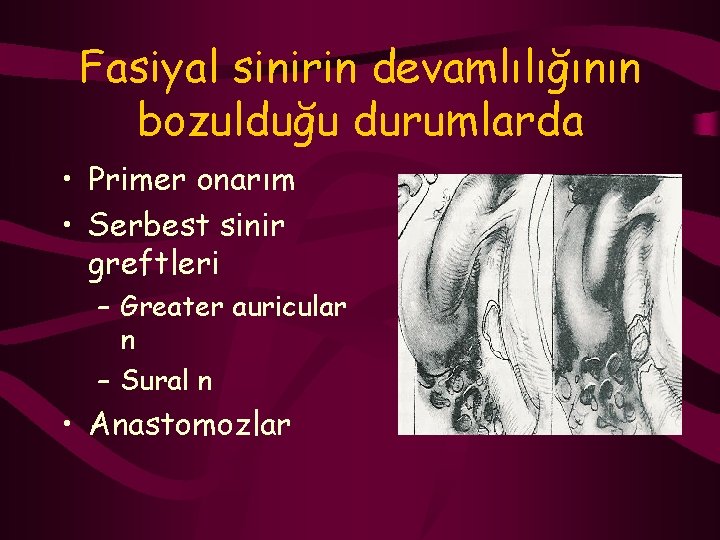 Fasiyal sinirin devamlılığının bozulduğu durumlarda • Primer onarım • Serbest sinir greftleri – Greater