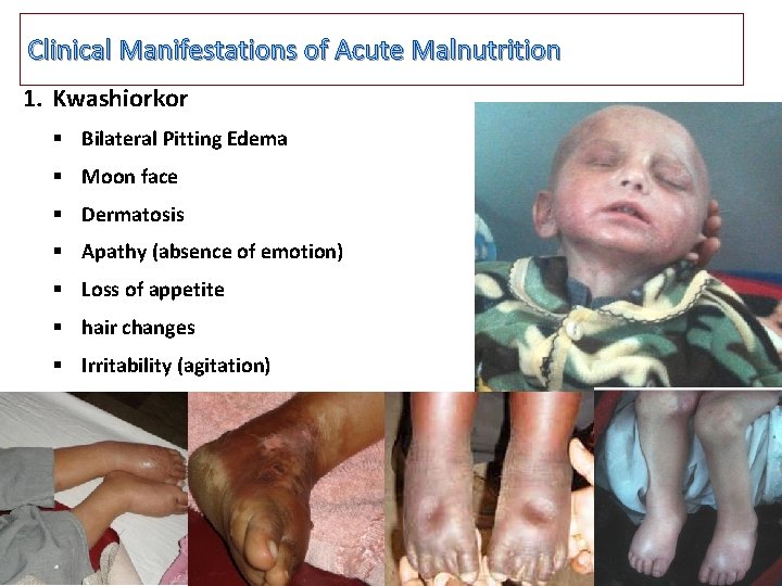 Clinical Manifestations of Acute Malnutrition 1. Kwashiorkor § Bilateral Pitting Edema § Moon face