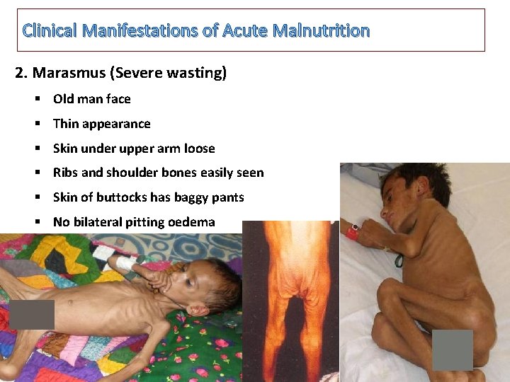 Clinical Manifestations of Acute Malnutrition 2. Marasmus (Severe wasting) § Old man face §