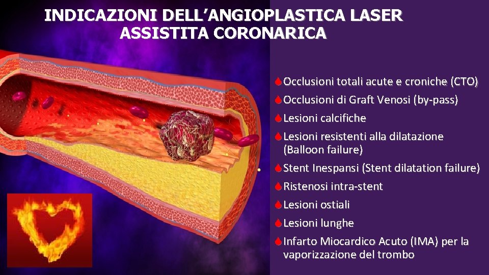 INDICAZIONI DELL’ANGIOPLASTICA LASER ASSISTITA CORONARICA Occlusioni totali acute e croniche (CTO) Occlusioni di Graft