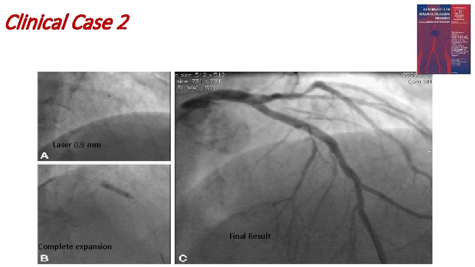 Clinical Case 2 Laser 0. 9 mm Complete expansion Final Result 