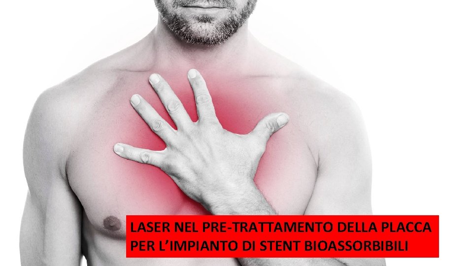 LASER NEL PRE-TRATTAMENTO DELLA PLACCA PER L’IMPIANTO DI STENT BIOASSORBIBILI 