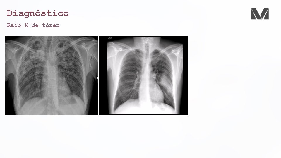 Diagnóstico Raio X de tórax 