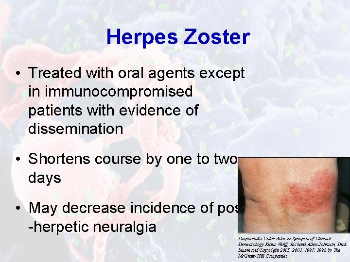 Herpes Zoster • Treated with oral agents except in immunocompromised patients with evidence of