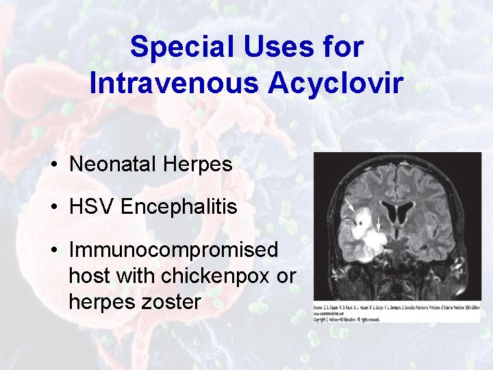 Special Uses for Intravenous Acyclovir • Neonatal Herpes • HSV Encephalitis • Immunocompromised host