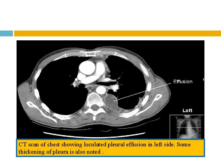 CT scan of chest showing loculated pleural effusion in left side. Some thickening of