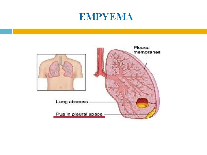 EMPYEMA EMPYEMA