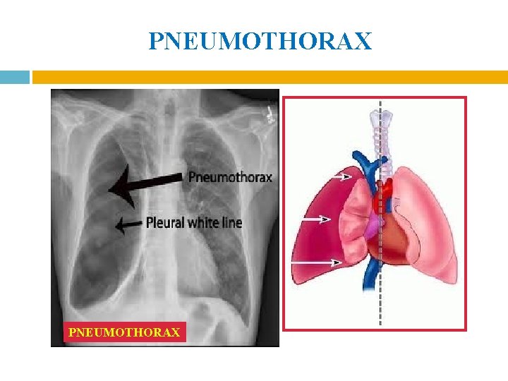 PNEUMOTHORAX 