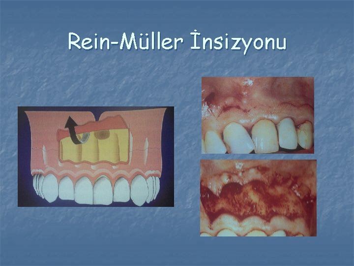 Rein-Müller İnsizyonu Rein-Müller İnsizyonu