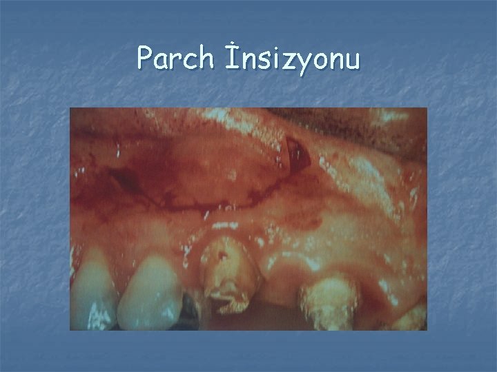Parch İnsizyonu Parch İnsizyonu