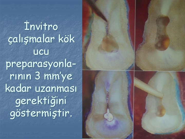 İnvitro çalışmalar kök ucu preparasyonlarının 3 mm’ye kadar uzanması gerektiğini göstermiştir. İnvitro çalışmalar kök ucu preparasyonlarının 3 mm’ye kadar uzanması gerektiğini göstermiştir.